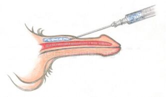 Prostorna injekcija hialuronske kisline v penis